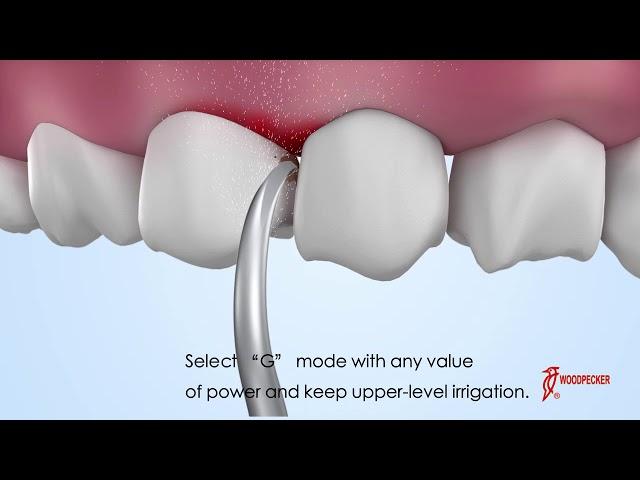 【G tips】Remove the supragingival, inter and cervical dental calculus with G9(GD9/GS9) tips