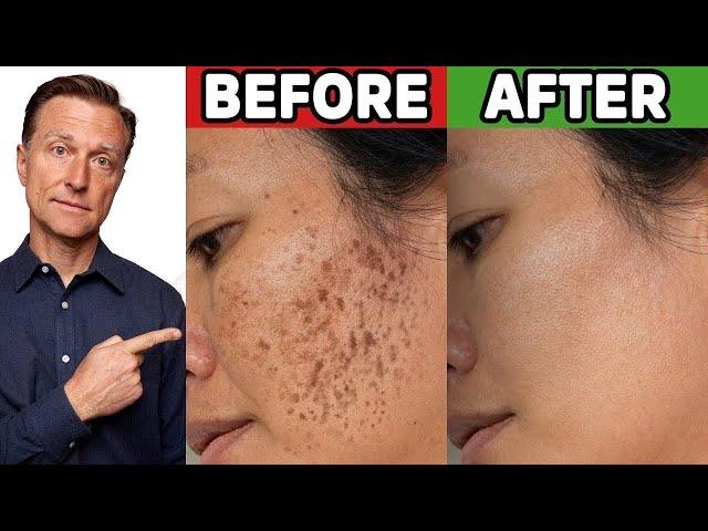 How to Get Rid of Hyperpigmentation (Aging or Dark Spots)