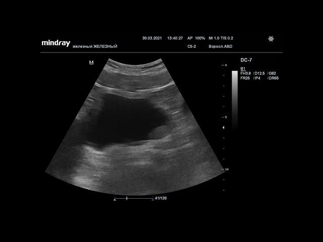 Ультразвуковая диагностика (УЗИ). Доктор Иогансен. Видеопримеры. Выпуск 13. Опухоли мочевого пузыря.