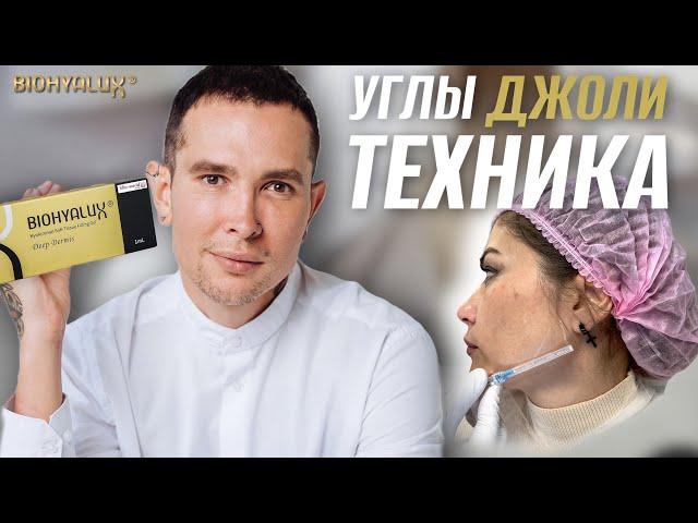 УГЛЫ ДЖОЛИ | СКУЛЫ контурная пластика #скулы #углыджоли #biohyalux