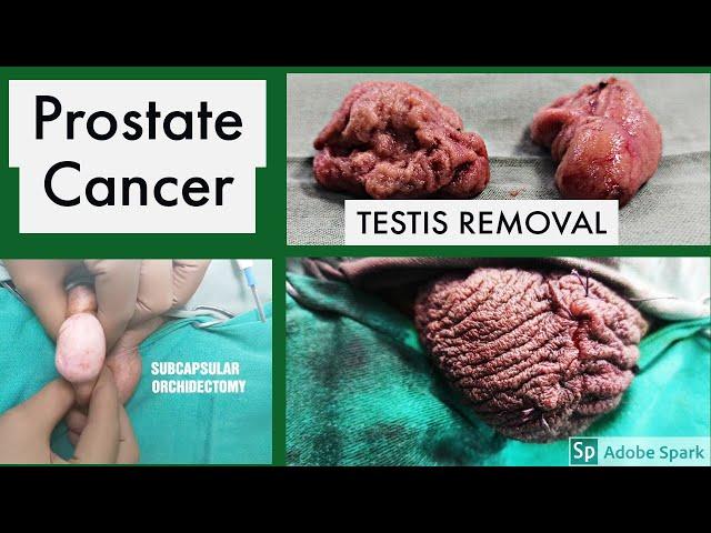 Testis Removal surgery in prostate cancer