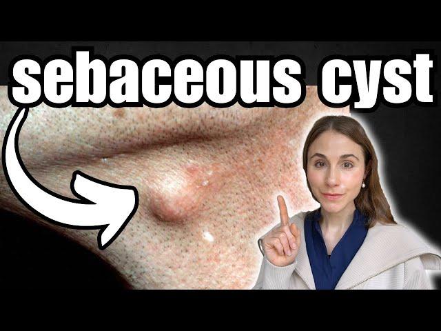 The Only Way To Remove A Sebaceous Cyst