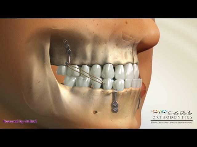 Bone Anchored Maxillary Protraction - Orthodontic Treatment