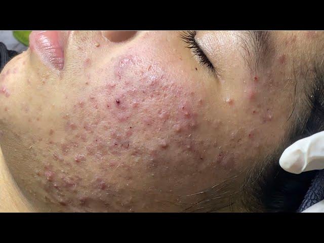 Acne treatment for Spa Linh Mun 2024 #60