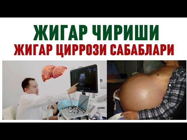 ЖИГАР ЧИРИШИ ЦИРРОЗ САБАБЛАРИ / БЕЛГИЛАРИ / ТАШХИС / ГЕПАТИТ В, С, АСОРАТИ ЭРТА ЎЛИМ ОМИЛИ