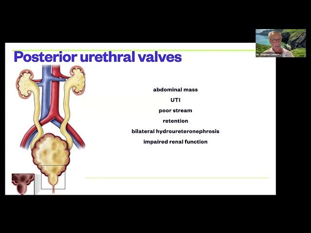 Congenital Urologic Anomalies with Dr. Stephen Lieberman - July 09, 2024