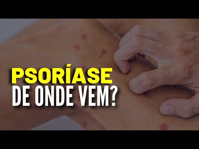 Psoríase - De Onde Vem a Psoríase