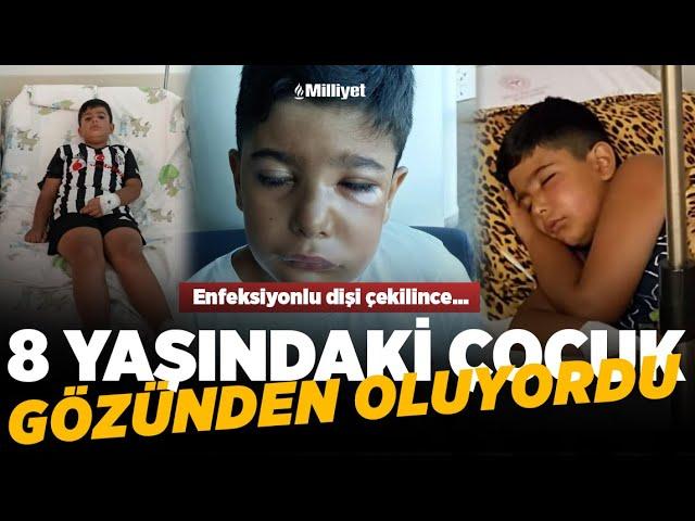 Enfeksiyonlu dişi çekilen çocuk gözünden oluyordu