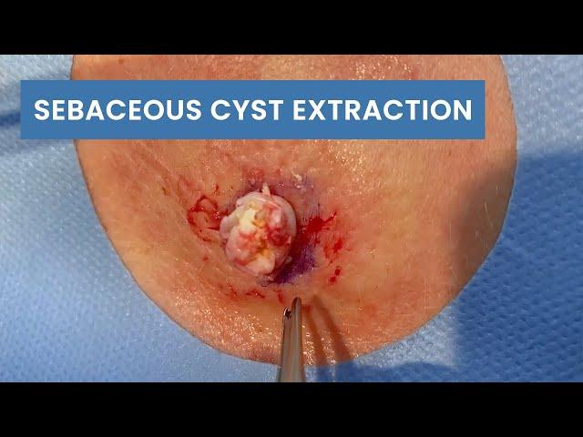 Sebaceous Cyst Extraction | CONTOUR DERMATOLOGY