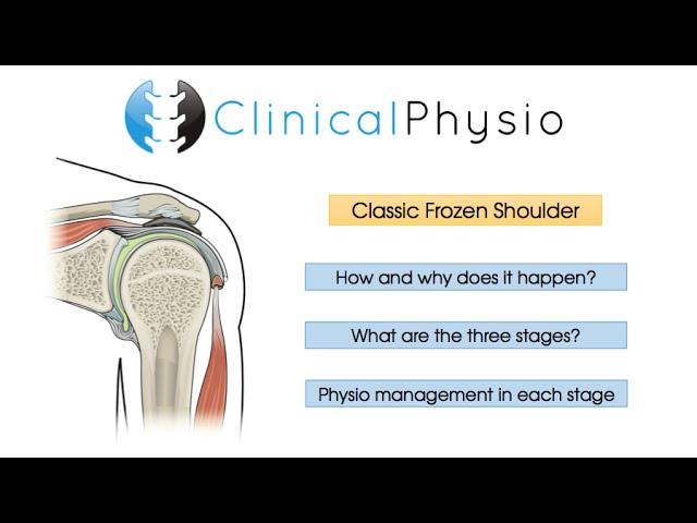 Classic Frozen Shoulder | Clinical Physio