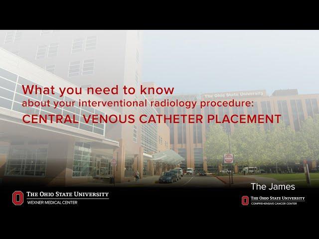 Central venous catheter placement | Ohio State Medical Center