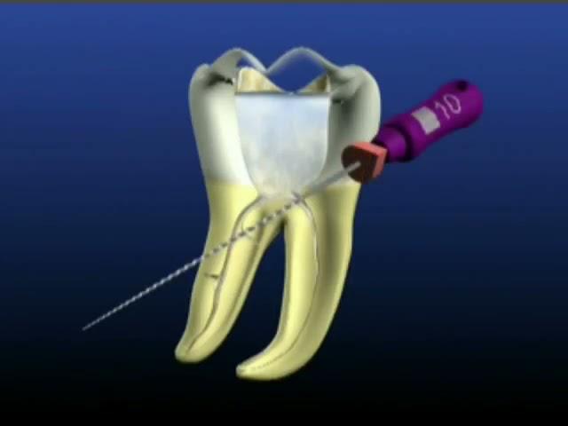 ProTaper Rotary File Technique | pinkblue.in