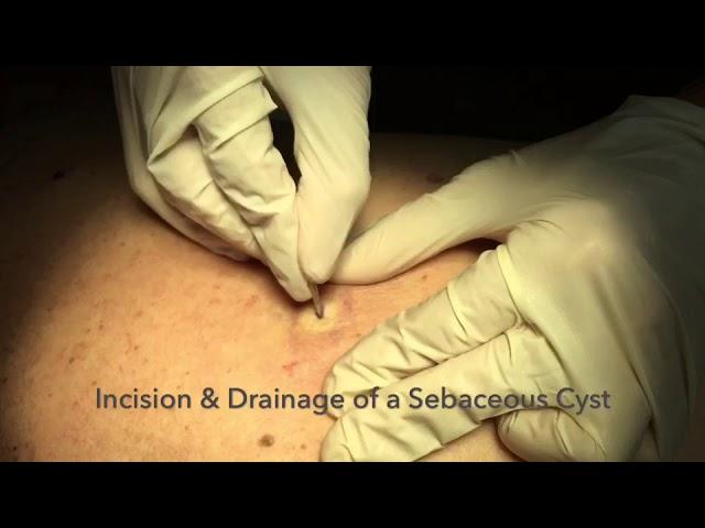 Incision & Drainage of a Sebaceous Cyst