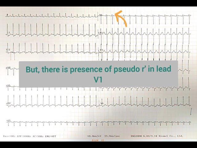 ECG Quiz 19 @LearningCardiology