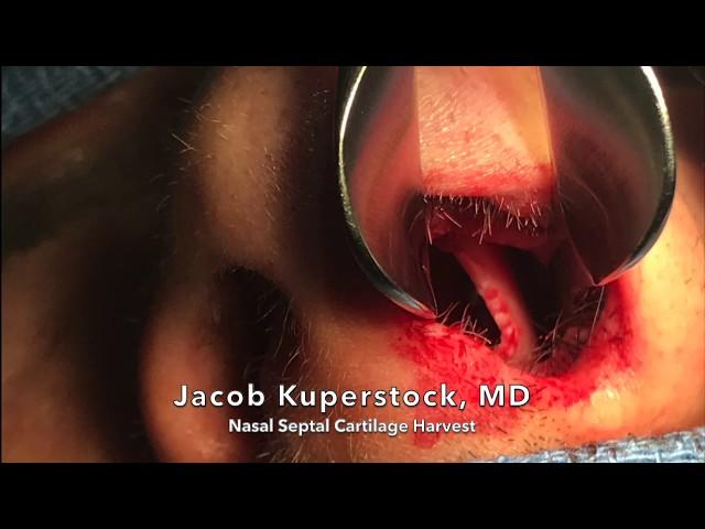 Nasal Septal Cartilage Harvest