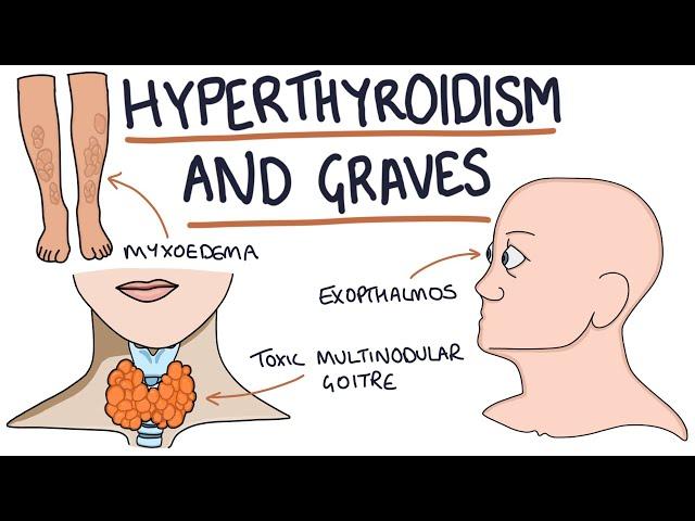 Understanding Hyperthyroidism and Graves Disease