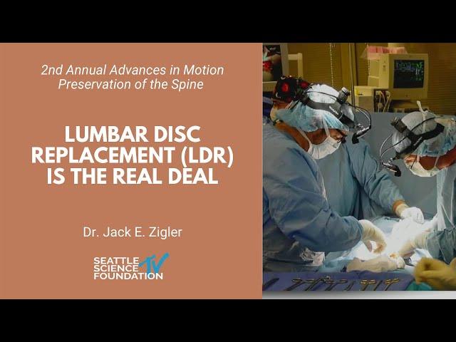 Lumbar Disc Replacement LDR Is the Real Deal - Jack E. Zigler, MD