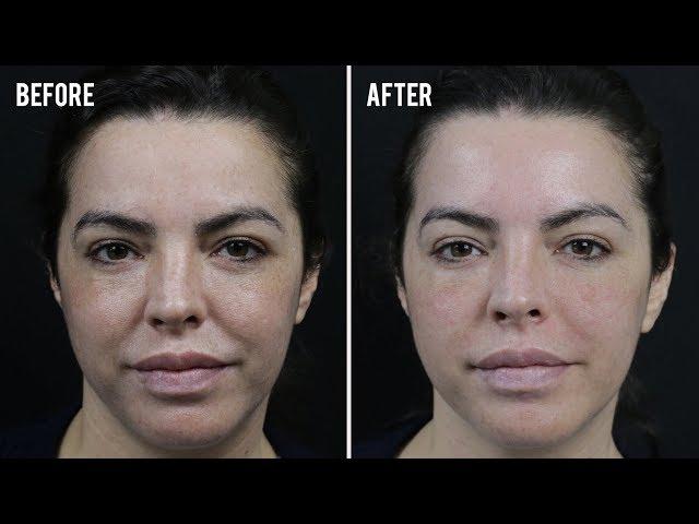 Nose-to-Mouth Treatment | Before & After | SkinViva