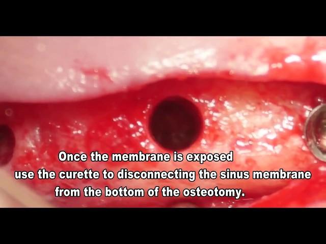 Safe Sinus Lift Kit Surgery Instructions - MSDI dental implanst