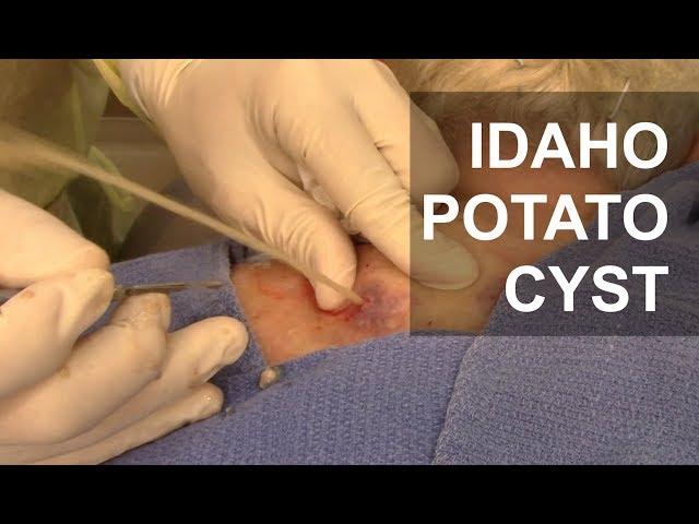 EXPLOSIVE Idaho Potato Cyst!! | Dr. Derm