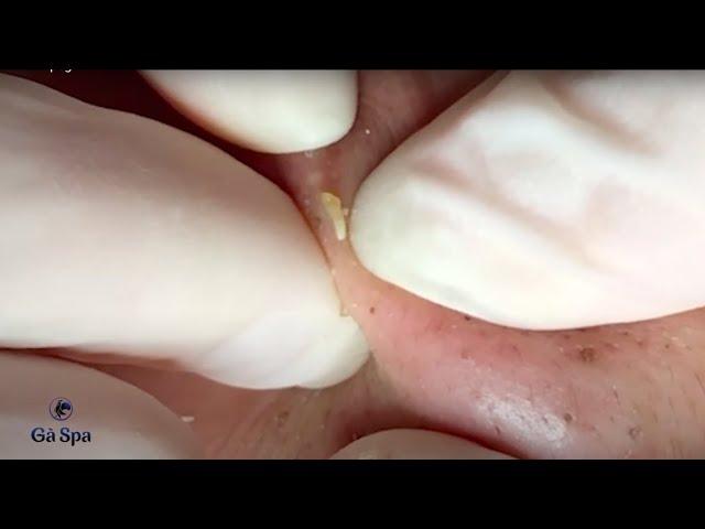 SIGNATURE SERVICE: Acnes Treatment (Ver.6) | Blackhead Popping