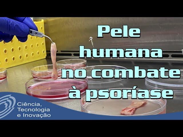 A biologia em busca de novos tratamentos contra a psoríase