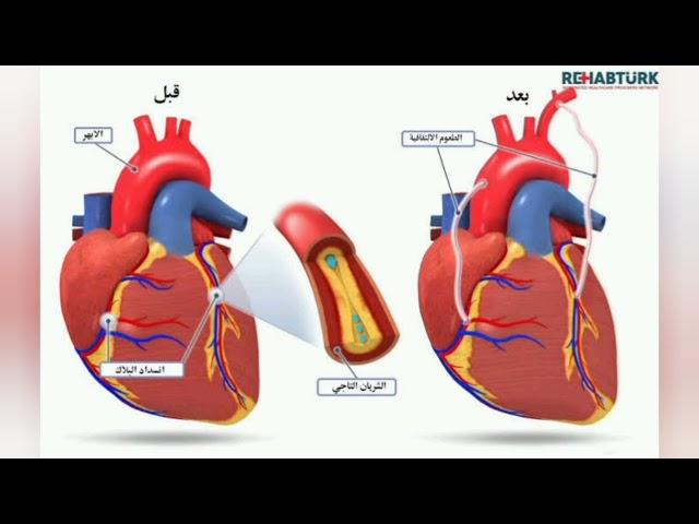 ازاي احافظ على الشرايين المزروعة بعد عملية القلب المفتوح أو القلب النابض لترقييع الشرايين التاجية