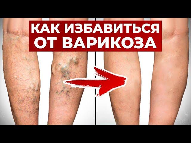 Как убрать варикоз БЕЗ ОПЕРАЦИИ? / НОГИ БОЛЬШЕ БОЛЕТЬ НЕ БУДУТ!