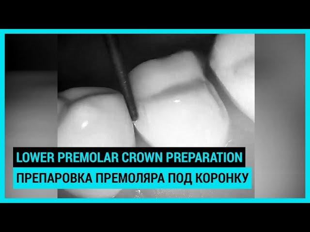 Lower premolar crown preparation. Препаровка нижнего премоляра под коронку.