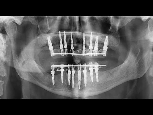 Full mouth reconstruction using Noris Medical implants system | by Prof. Ziv Mazor, Periodontist