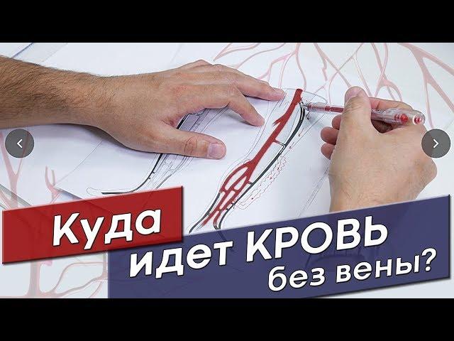 Куда пойдет кровь после удаления варикоза?