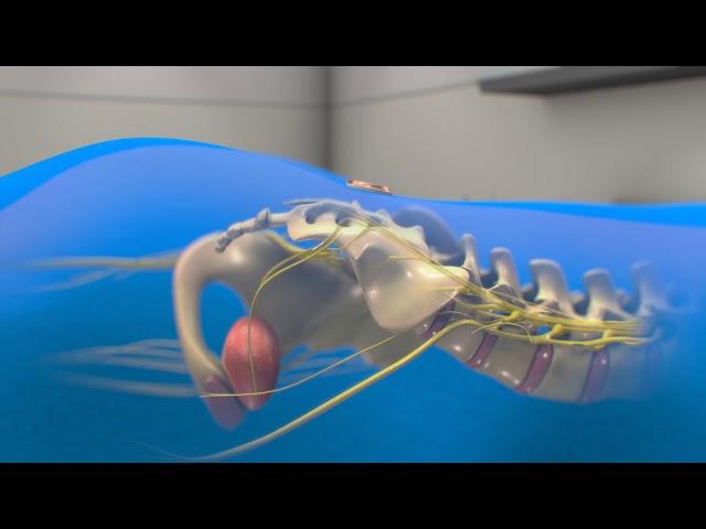 Neuspera Sacral Neuromodulation System for Urinary Urgency Incontinence (UUI) - 3D animation