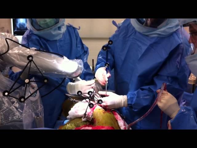 Total Hip Replacement Using MAKO Robotic Assistance