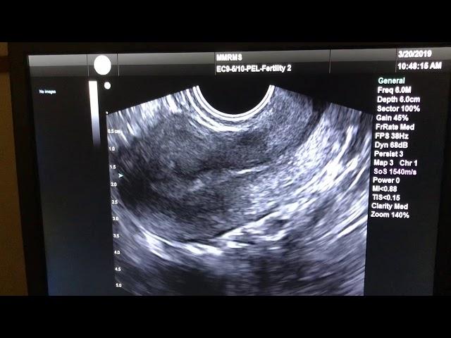 Transvaginal Ultrasound