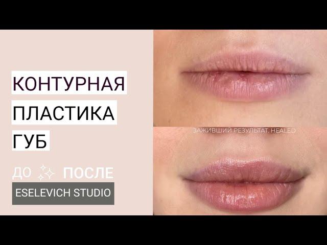 Контурная пластика губ. Какой объем гиалуроновой кислоты лучше колоть в губы? Препарат Juvederm