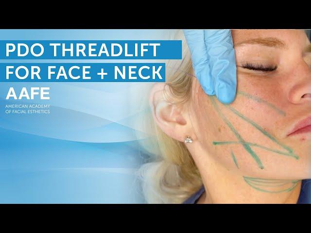 Non-Surgical Face and Neck Lift with PDO Lifting Threads | AAFE