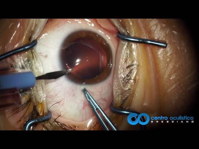 Phakic IOL - ICL Staar Visian Implantation Technique