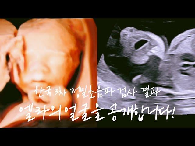 Shocking News After Diagnosis of Cleft Lip.. | Ella's 4D Ultrasound Face  | Return to Korea