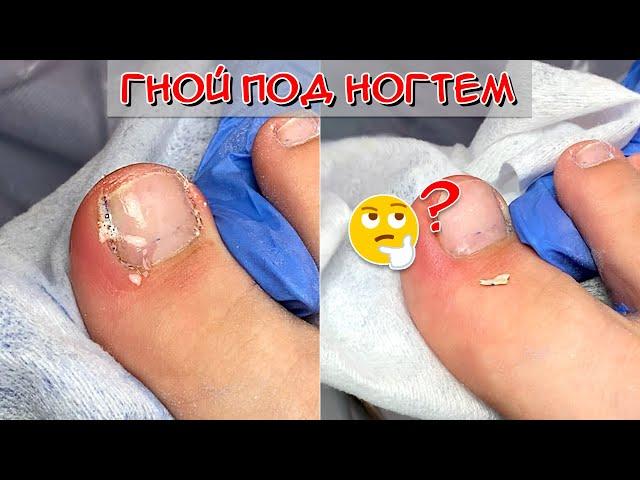 Pus under the nail  Ingrown toenail