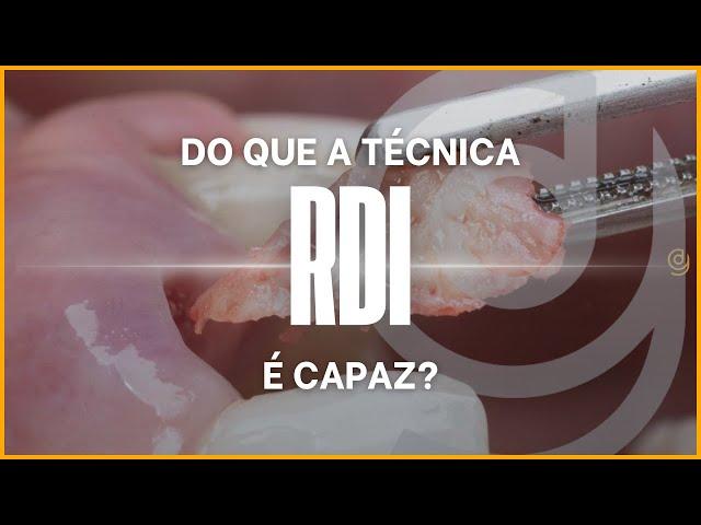 Implantodontia estética não se resume a preencher o gap com biomaterial!