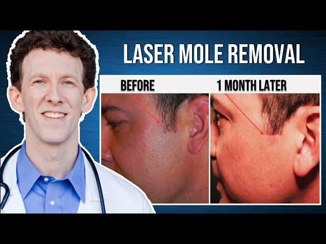 Laser Mole Removal | Live Procedure