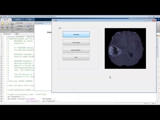 Brain tumor segmentation Convolutional neural network matlab projects