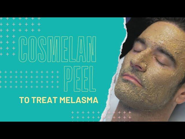 Cosmelan Peel to Treat Melasma | Dr. Jason Emer