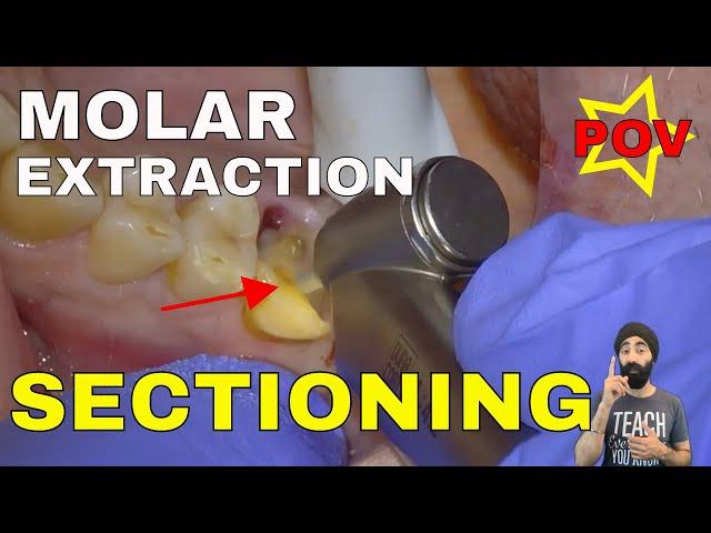 CLINICAL TUTORIAL: Upper Molar EXTRACTION with Electric Handpiece Section and Elevate FLAPLESS