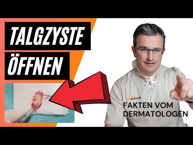 TALGZYSTE (Talgdrüse, Atherom) ÖFFNEN - Woraus besteht dieser Knoten? #talgzyste #pickel