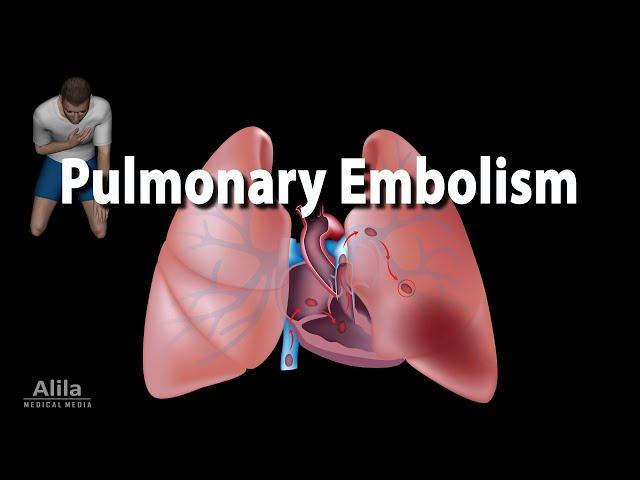 Pulmonary Embolism, Animation