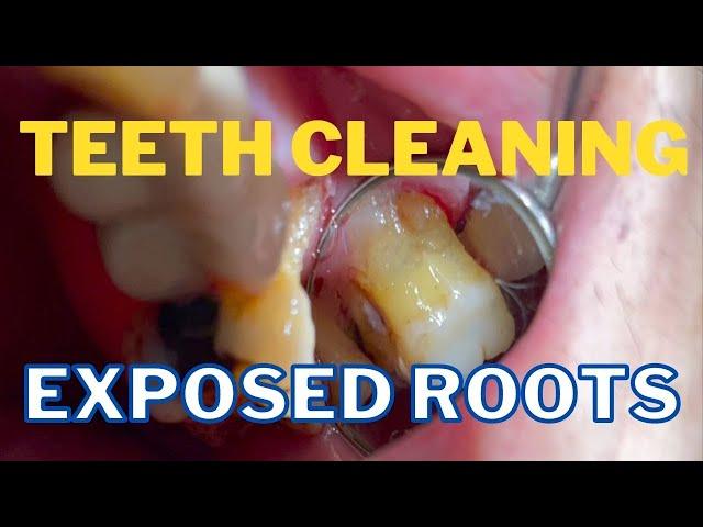 Dental Cleaning  Large Hidden Tartar in the Back Teeth 