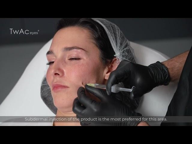 TwAc Eyes using in the lower third of the face