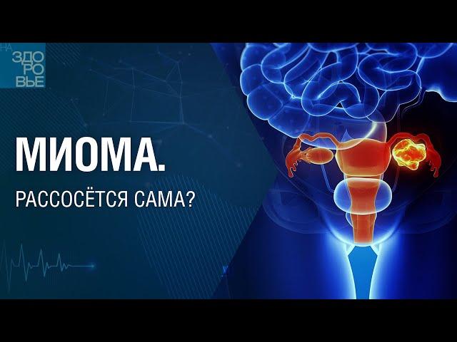 Миома. Рассосётся сама? На здоровье 02.07.2022