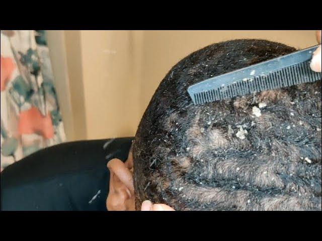 Big Flakes Return?! | Morning Dandruff Scratching